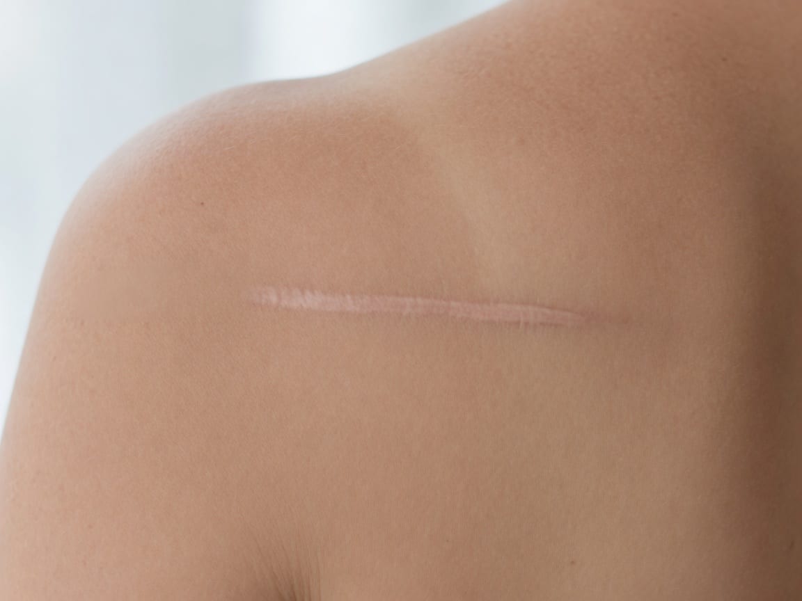 Medium Scar (2-4 inches) permanent makeup