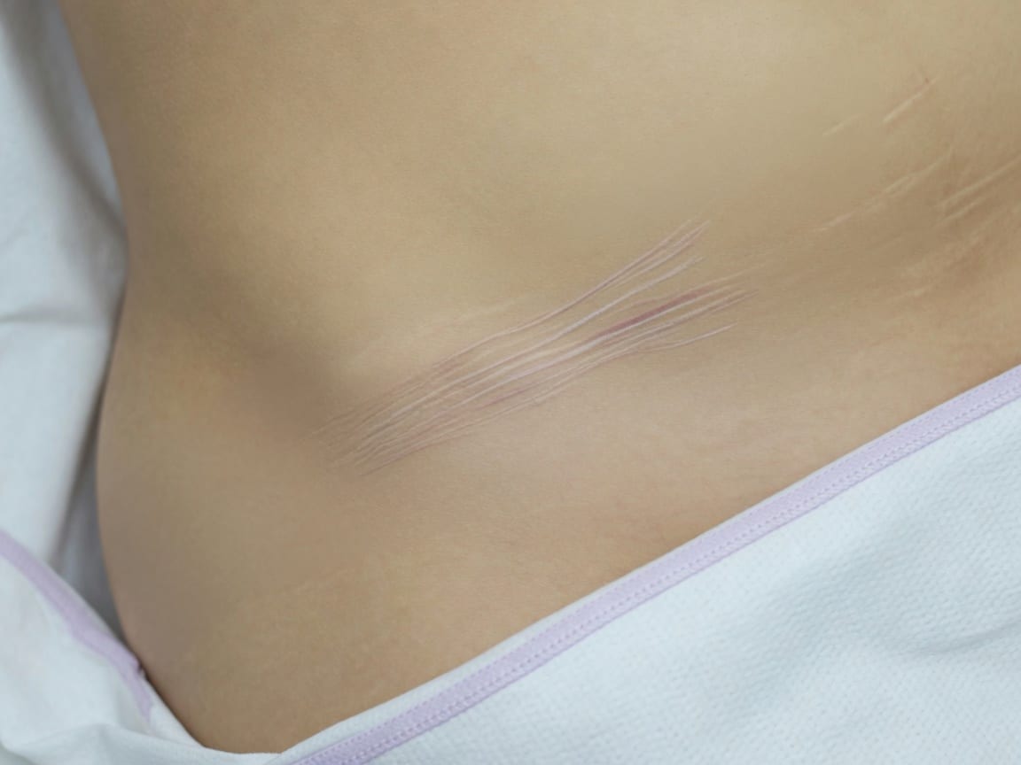 Stretch Marks (large area / abdomen / thighs) permanent makeup
